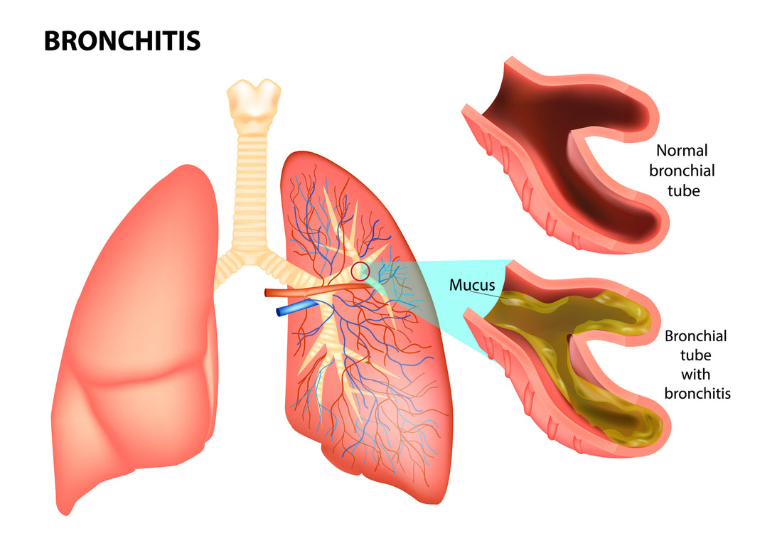 Antibiotics Don’t Work For Acute Bronchitis
