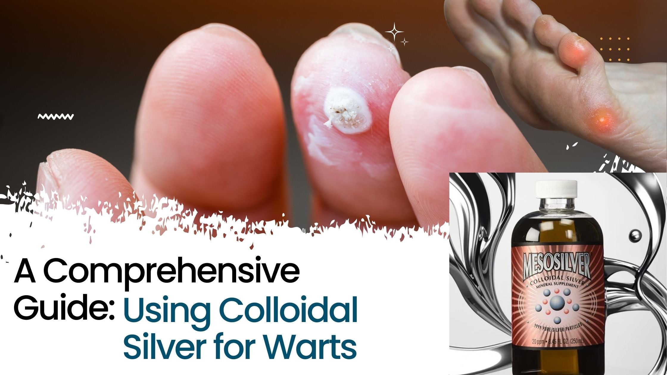 A Comprehensive Guide: Using Colloidal Silver for Warts – Colloidsforlife